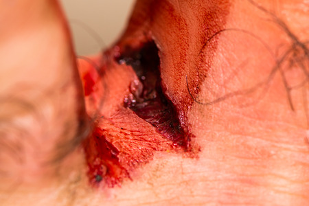 Close up of deep cut between first and second toes. Foot injury breaking skin between digits, exposing dark red tissueの写真素材