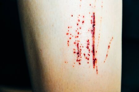 The wound form scabs. The wound happen during young man playing footbal and fall down on the footbal fieldの写真素材