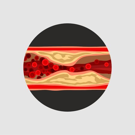 artery with blood cells deseaseのイラスト素材