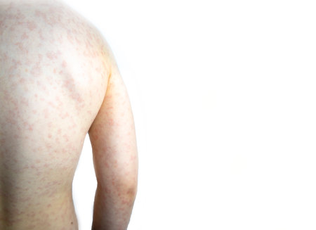 Rash on the childs body on a white background. High quality photoの写真素材