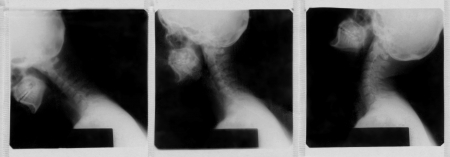 X-Ray image of a human cervical spineの写真素材