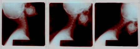 X-Ray image of a human cervical spine