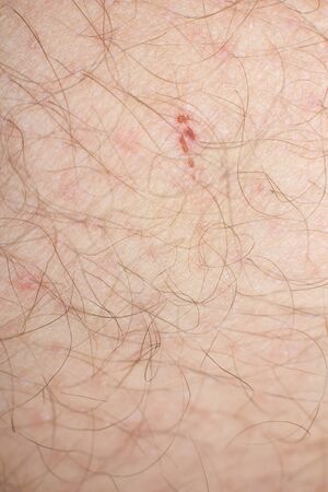 Human skin with wounds and without wounds closeの写真素材