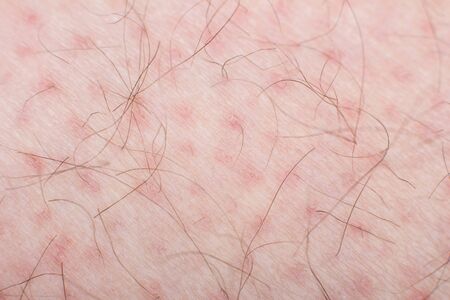 Human skin with wounds and without wounds closeの写真素材
