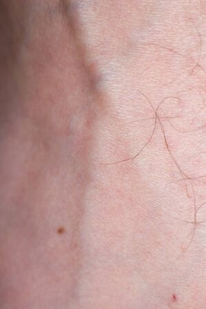 Human skin with wounds and without wounds closeの写真素材