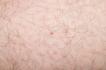 Human skin with wounds and without wounds closeの写真素材