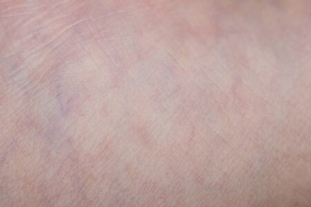 Human skin with wounds and without wounds closeの写真素材