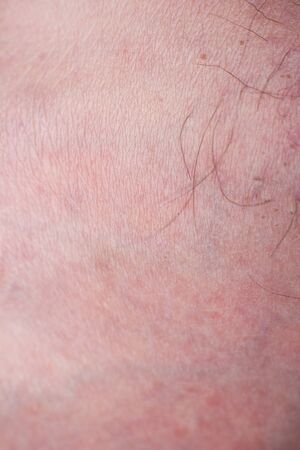 Human skin with wounds and without wounds closeの写真素材