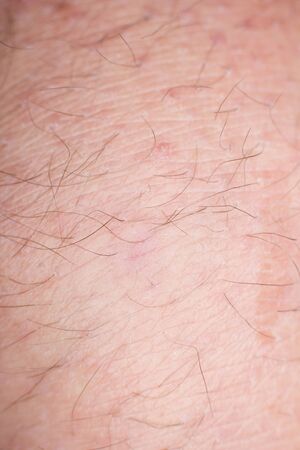 Human skin with wounds and without wounds closeの写真素材
