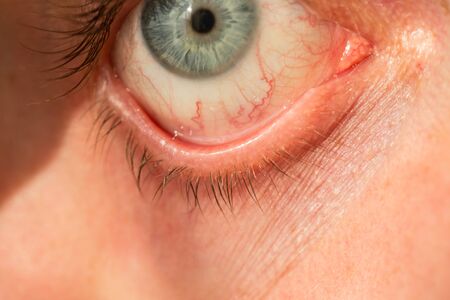 The man's eye is gray-blue with red veins on it very closeの写真素材