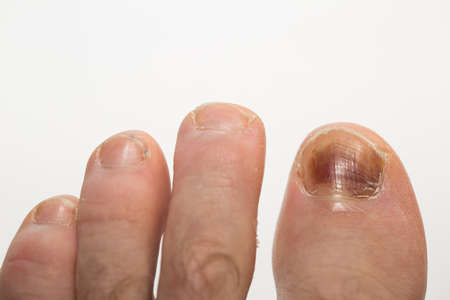 A bruised finger after a blow, a bruise on the fingerの写真素材