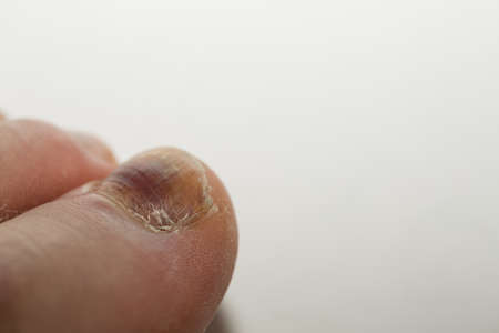 A bruised finger after a blow, a bruise on the fingerの写真素材