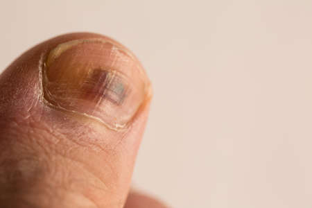 A bruised finger after a blow, a bruise on the finger