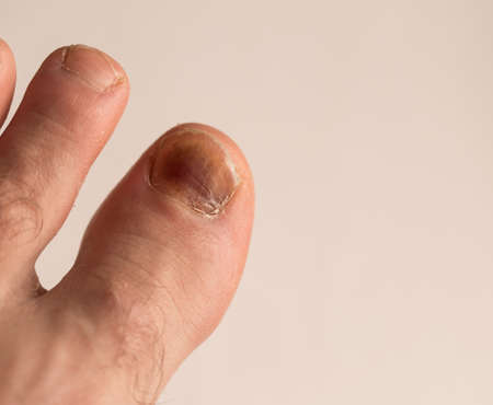 A bruised finger after a blow, a bruise on the fingerの写真素材