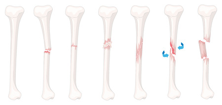 Different stages of leg fracture illustrationのイラスト素材