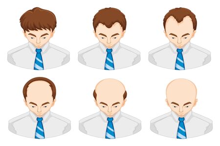 Stages of hair loss in manのイラスト素材