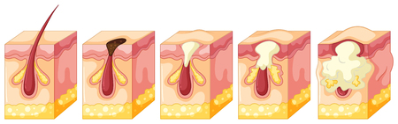 Diagram of pimple on human skin illustrationのイラスト素材