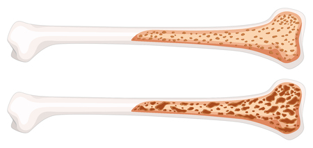 Osteoporosis in human bone illustrationのイラスト素材