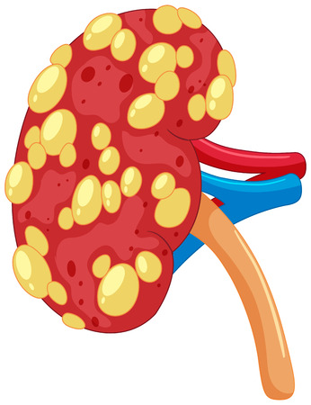 Close up kidney with disease illustrationのイラスト素材