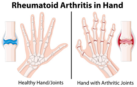 Diagram showing rheumatoid arthritis in hand illustrationのイラスト素材