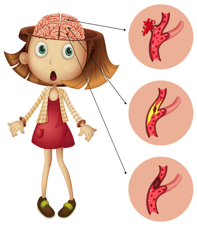 Girl with brain strokes diagram illustrationのイラスト素材