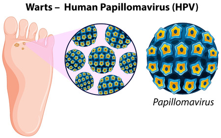 Diagram showing warts in human foot illustrationのイラスト素材