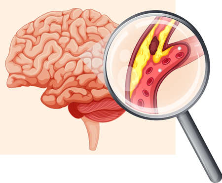Human Brain with Atherosclerosis illustrationのイラスト素材