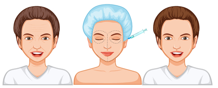 Comparison of female botox injection illustrationのイラスト素材
