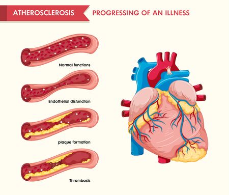 Scientific medical illustration of atherosclerosis illustrationのイラスト素材