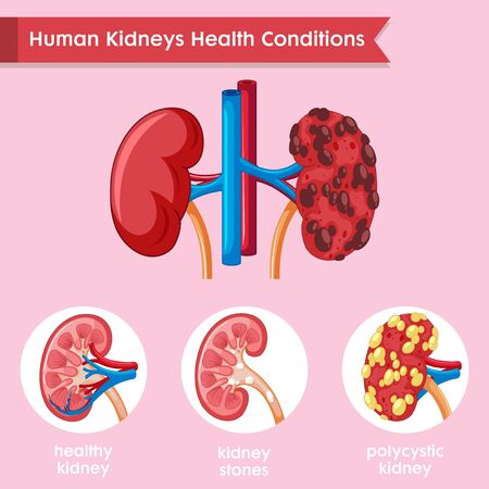 Scientific medical illustration of kidney disease illustrationのイラスト素材