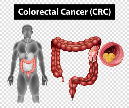 Diagram showing Colorectal Cancer (CRC) on transparent background illustrationのイラスト素材