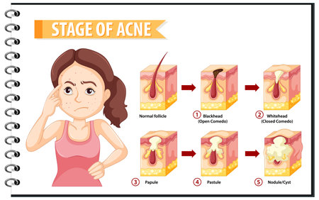 Stages of skin acne anatomy with a woman doing stressful pose illustrationのイラスト素材