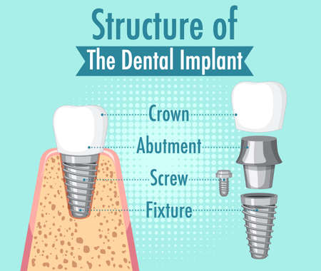 Infographic of human in structure of the dental implant illustrationのイラスト素材