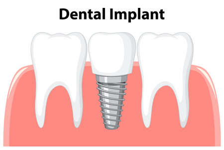 Dental implant in gum on white background illustrationのイラスト素材