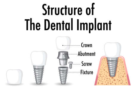 Infographic of human in structure of the dental implant illustration