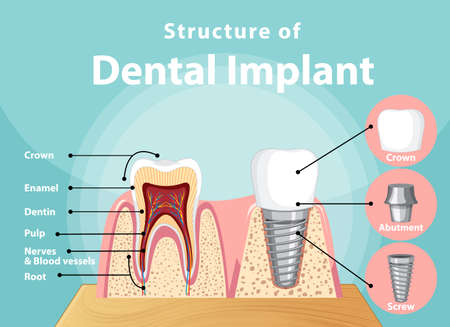 Infographic of human in structure of the dental implant illustrationのイラスト素材