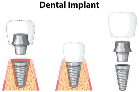 Dental implant in gum on white background illustration