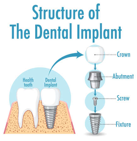 Infographic of human in structure of the dental implant illustrationのイラスト素材