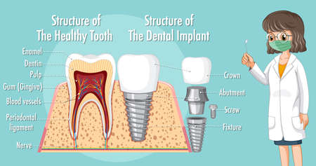 Infographic of human in structure of the dental implant illustrationのイラスト素材