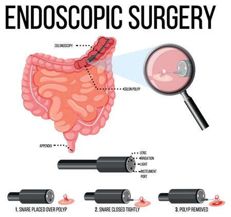Diagram showing endoscopic surgery illustrationのイラスト素材