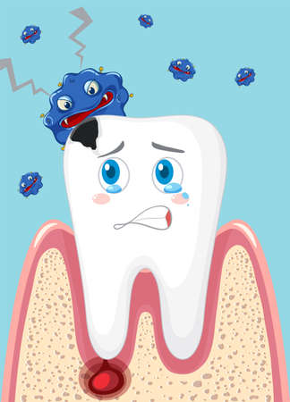 Cartoon tooth decay with bacteria on blue background illustrationのイラスト素材
