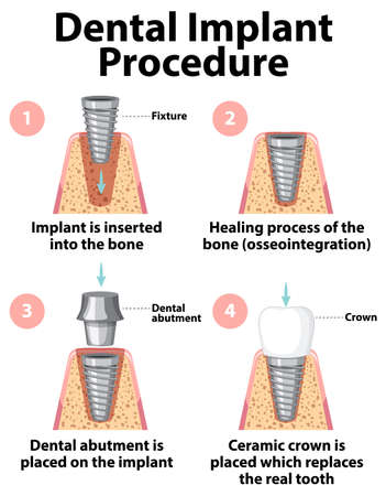 Infographic of human in structure of the dental implant illustrationのイラスト素材