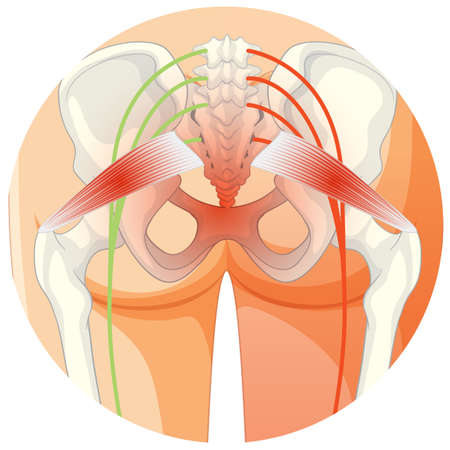 Lower back suffering from ankylosing spondylitis illustrationのイラスト素材