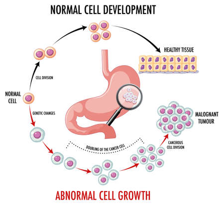 Diagram showing normal and cancer cells illustrationのイラスト素材