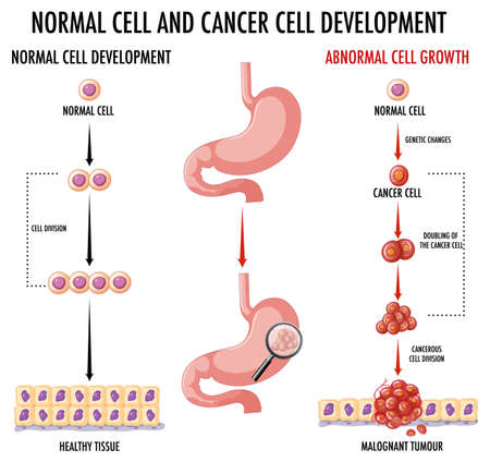 Diagram showing normal and cancer cell illustrationのイラスト素材