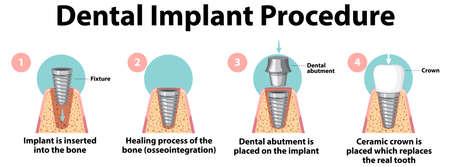 Infographic of human in dental implant procedure illustrationのイラスト素材