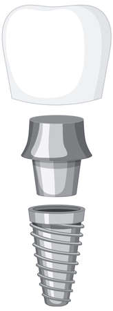 Dental implant  on white background illustrationのイラスト素材