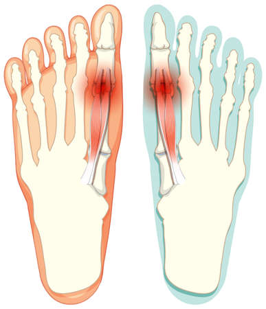 Hallux valgus types on white background illustrationのイラスト素材