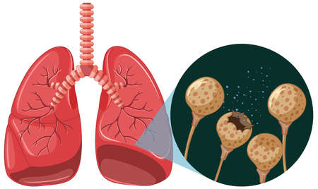 The mold spores grow in human lungs illustrationのイラスト素材