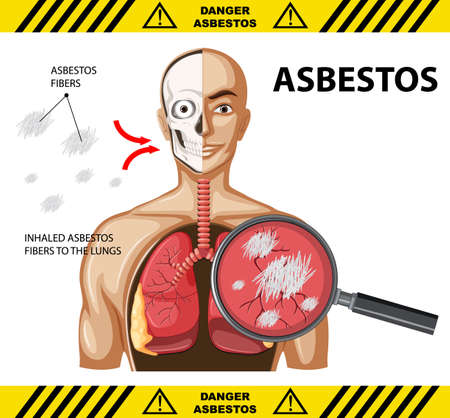 Diagram showing asbestosis in lungs illustrationのイラスト素材